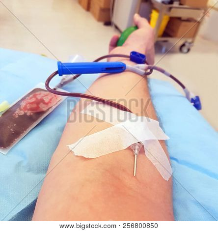Blood Donor Arm During Plasmapheresis In A Hospital Facility And
