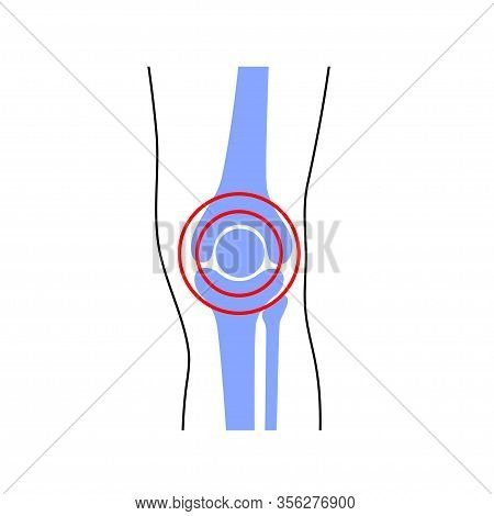 Knee Joint Problem. Pain In The Leg Symbol. Vector Flat Concept Illustration. Isolated On White Back