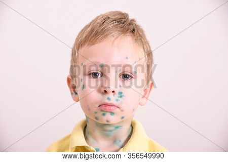 Young Toddler,boy With Chickenpox. Sick Child With Chickenpox. Varicella Virus Or Chickenpox Bubble