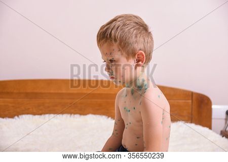 Young Toddler,boy With Chickenpox. Sick Child With Chickenpox. Varicella Virus Or Chickenpox Bubble