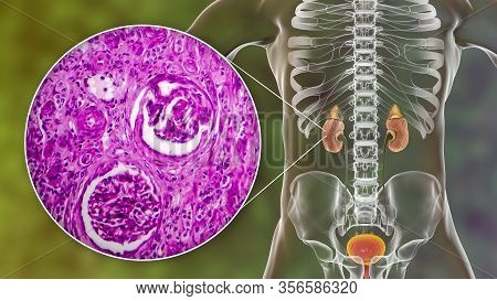 Chronic Glomerulonephritis, 3d Illustration Showing Pale Contracted Coarsely Granular Kidneys And Li