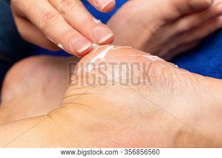Applying Cream On The Feet Sole For The Treatment Of Corn, Callus, Callosity, Cracks, Softening The