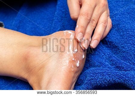 Applying Cream On The Feet Sole For The Treatment Of Corn, Callus, Callosity, Cracks, Softening The