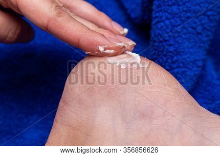 Applying Cream On The Feet Sole For The Treatment Of Corn, Callus, Callosity, Cracks, Softening The