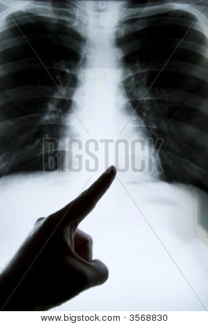 Hrudníku X-Ray polohovací