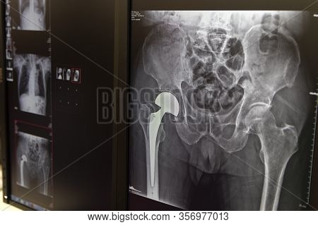X-ray Of The Hip Prosthesis Elderly Man