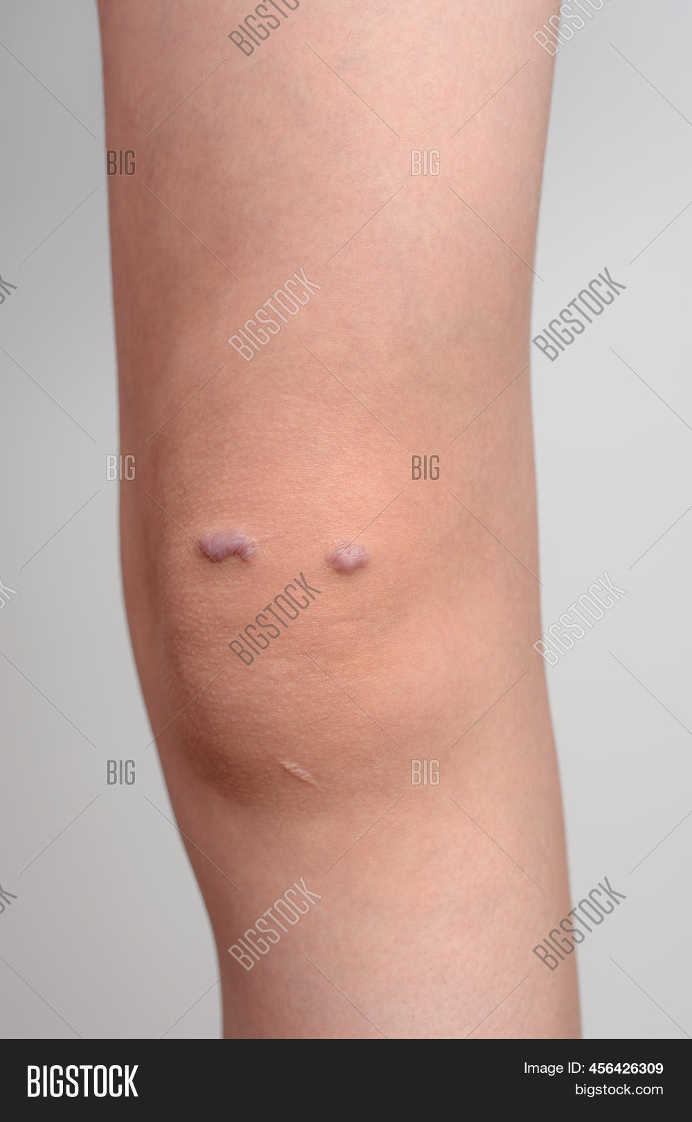 Knee Girl Keloid Scar Image & Photo (Free Trial) Bigstock