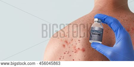 Doctors Hand Holding Monkeypox Vaccine With Male Back Affected By Blistering Rash Because Of Monkeyp