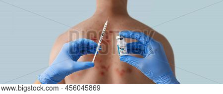 Doctors Hand Holding Monkeypox Vaccine With Male Back Affected By Blistering Rash Because Of Monkeyp