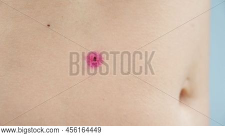 Close-up Of A Removed Wart On A Womans Abdomen. Human Papillomavirus After Burning.