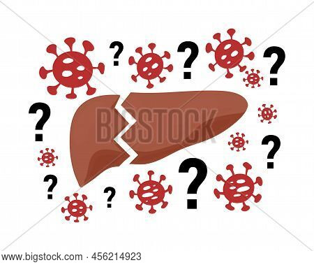 Mysterious Acute Hepatitis Of Unknown Cause Concept. Vector Illustration Of Damaged Liver With Bacte