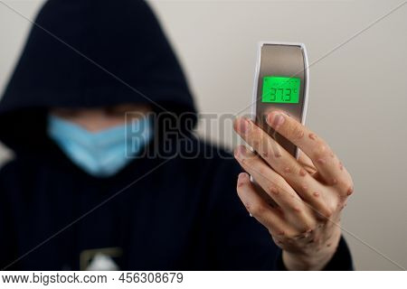 Infectred Person With Monkeypox Viral Rash Showing Termometer