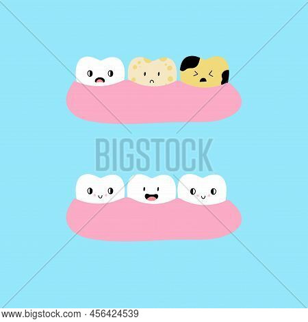 Cartoon Teeth In Gum. Healthy And With Caries, Cute Tooth Yellow And White Enamel, Before And After