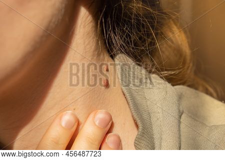 Birthmarks On Skin Close Up Detail Of The Bare Skin Sun Exposure Effect On Skin, Health Effects Of U