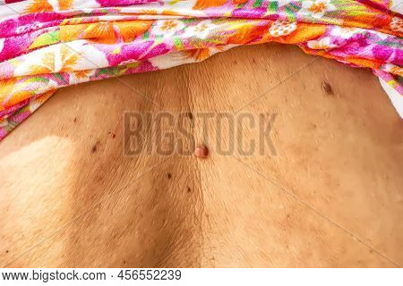 Skin Tag Or Acrochondon Or Soft Fibroma Is A Safe. It Have Not Effect To The Body. It Usually Occurs
