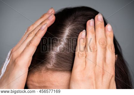 Close-up Of Woman With Thinning Hair On Head