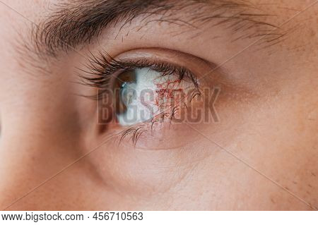 Ophthalmology. Human Eye Close-up With Red Vascular Mesh And Inflammation On The Eyeball. The Concep