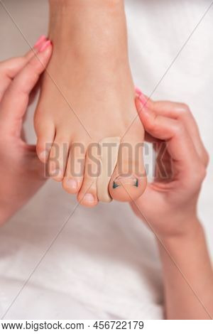 Podiatrist Inserts A Silicone Impression Between The Toes To Correct The Ingrown Toenail On The Thum