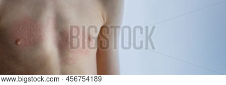 Urticaria On The Skin. Red Spots Of An Allergic Reaction On The Skin Of A Child. Urticaria Symptoms 