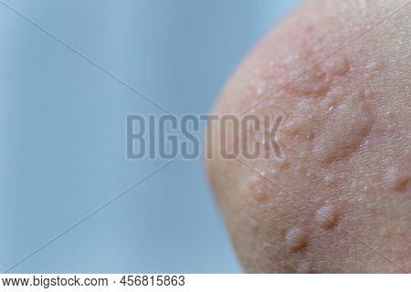 Urticaria On The Skin. Red Spots Of An Allergic Reaction On The Skin Of A Child. Urticaria Symptoms 