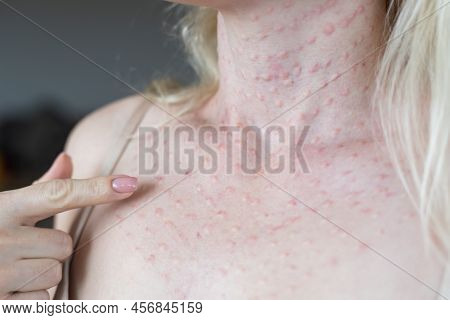 Real Skin Biorevitalization On White Background. Traces Of Biorevitalization Injections On Woman Fac
