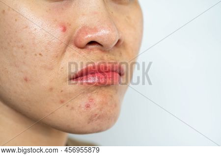 Cropped Shot Of Woman Having Problems Of Acne Inflamed On Her Face.