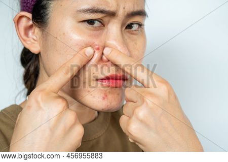 Asian Woman Pointing To Acne Inflamed On Her Face. Inflamed Acne Consists Of Swelling, Redness, And 