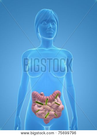 colon infection