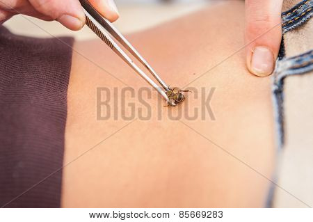 Apitherapy Treatment