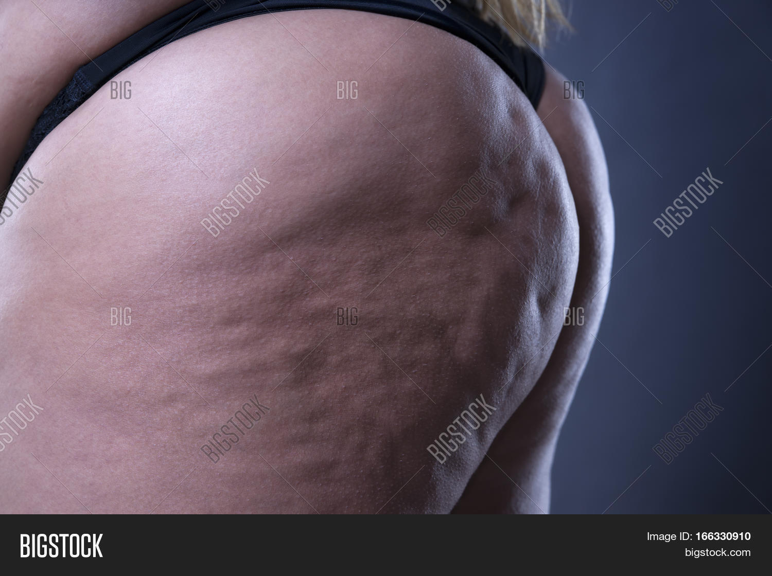 Fat Cellulite Butts Fat Cellulite Butts