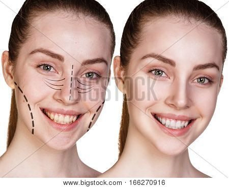 Collage of young woman with lifting arrows and without. Before and after liffting