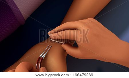 Hemodialysis is a process that uses a man-made membrane (dialyzer) to: Remove wastes, such as urea, from the blood.