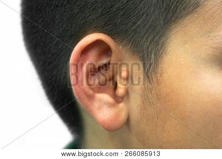 Pre-auricular Skin Tag / Preauricular Tags On Ear