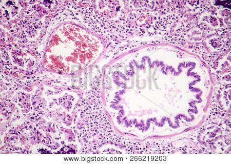 Lobar Pneumonia, Red Hepatic Phase, Light Micrograph, Photo Under Microscope
