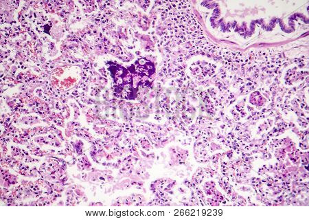 Lobar Pneumonia, Red Hepatic Phase, Light Micrograph, Photo Under Microscope