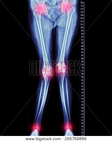 X-ray Image Of  Lower Limb Human Or Scanogram  . Medical Background Concept.
