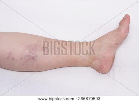 Varicose Veins On A Womans Leg, White Background, Vascular Pattern From Varicose Veins On The Calf O