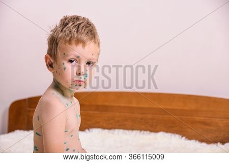 Young Toddler,boy With Chickenpox. Sick Child With Chickenpox. Varicella Virus Or Chickenpox Bubble