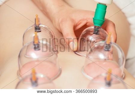Close Up Hand Puts Vacuum Cups On Back Of Woman During Medical Cupping Therapy.