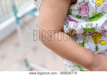 Boy With Symptoms Hand, Foot And Mouth Disease . Children \