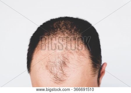 Male Pattern Hair Loss Problem Concept. Baldness, Alopecia In Males.