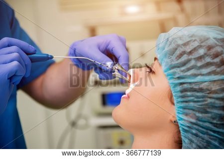 Laser Vaporization Of Nasal Concha With Coblation Technology Method