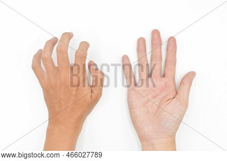 Hand Muscle Spasm In Asian Young Man. Unilateral Fingers Flexion. Isolated On White Background.