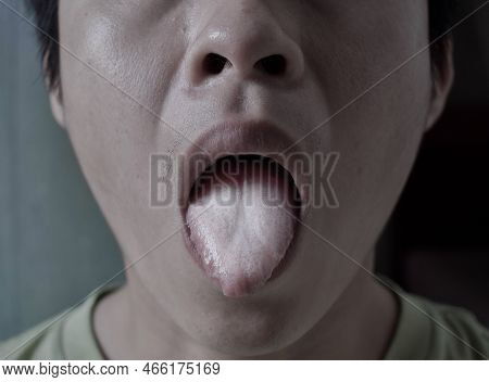 Coated Tongue Or White Tongue Of Asian, Chinese Man. It Appears With White Layer When Debris, Bacter