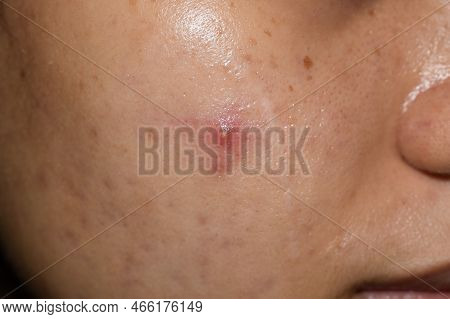 Single Cystic Acne Vulgaris On Oily Face Of Southeast Asian Young Woman.