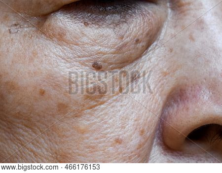 Small Brown Patches Called Age Spots On The Cheek Of Asian Elder Woman. They Are Also Called Liver S