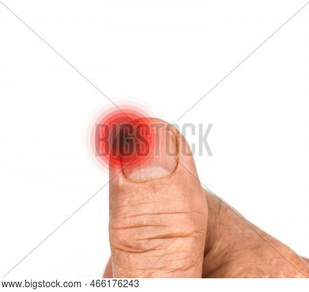 Inflammation At The Tip Of Fingernail. Concept Of Paronychia At Thumb Of Asian Old Man. Painful Fing