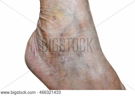Prominent Veins Visible Through The Thin Skin Of Asian Old Woman.