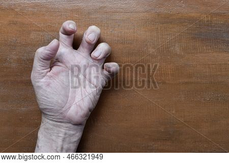 Volkmann Contracture In Left Upper Limb Of Southeast Asian Elder Man. It Is A Permanent Shortening O