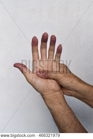 Cyanotic Hands Or Peripheral Cyanosis Or Blue Hands At Southeast Asian, Chinese Old Man